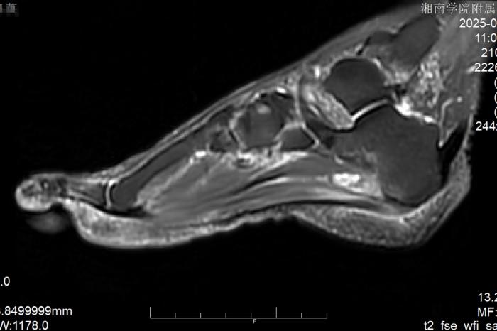 全市首例！关节镜跖筋膜松解术，助足跟痛患者重获“轻松步履”1 (1).jpg